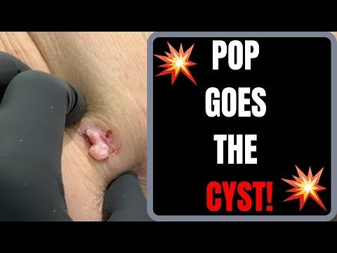POP GOES THE CYST!