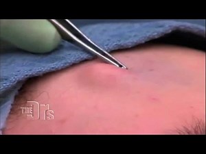 How to Get Rid of a Cyst.