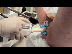 TP Pivot Pro™ Procedure