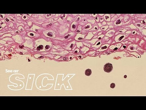 This Is How HPV Causes Cancer