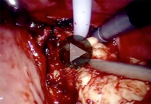 Robot-Assisted Simple Prostatectomy for Benign Prostatic Hyperplasia (Video)