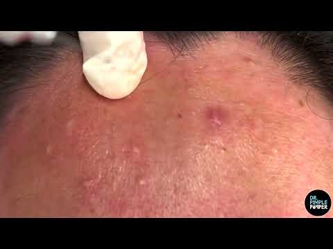 Comedones Galore on Face and Forehead! Dr Pimple Popper Pops & Removes Comedones
