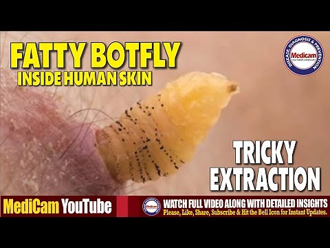 Botfly Larvae Removal Inside Human Skin | How to Extract Botfly Maggots Safely