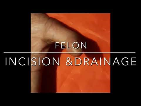Felon: incision and drainage. Digital nerve bolck. Infection of finger.