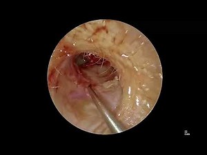 Endoscopic tympanoplasty: full surgery