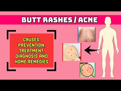 Butt Rashes & Booty Acne Prevention, Treatment & Home Remedies #buttocksacne