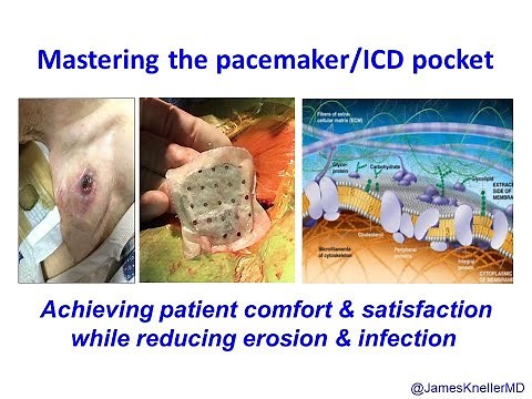 Mastering the Pacemaker/ICD pocket for patient satisfaction and to prevent infection