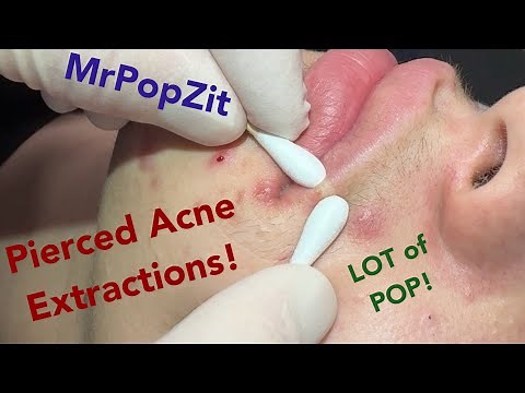NEW EXTRACTION VIDEO! Pierced acne. Blackheads, whiteheads, ingrown hairs. Tons of pop! Must see!