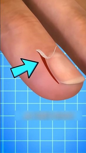 If You Ever Get a Hangnail, DON’T Peel It! (Causes, Fix & Prevention Explained)‼️😱