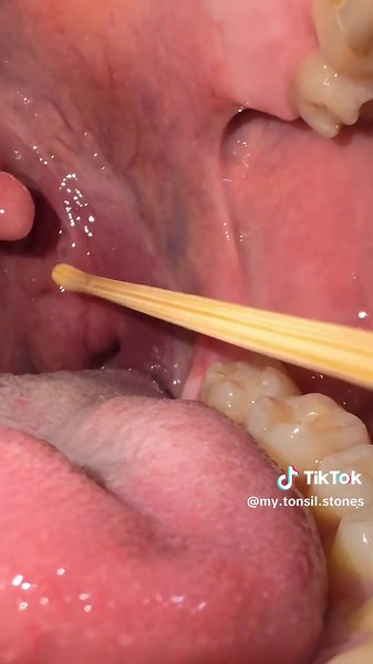 Tonsil Stone Removal ASMR for Your Comfort