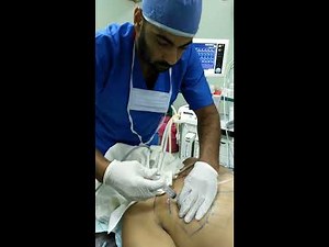 Loss of resistance technique in PECS 1 and 2 block confirmed by ultrasound