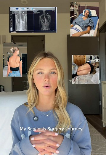 My scoliosis surgery journey 🤍 Timestamps: 2:57 surgery details 6:24 how much I grew from the surgery 7:15 passing out from the pain story 8:40 1 week follow up video 11:20 Scar updated picture 12:00 1 month post surgery update 13:30 was the surgery worth it? 13:43 my mobility after surgery #scoliosis #scoliosissurgery #scoliosisawareness #scoliosisstory #scoliosissurvivor