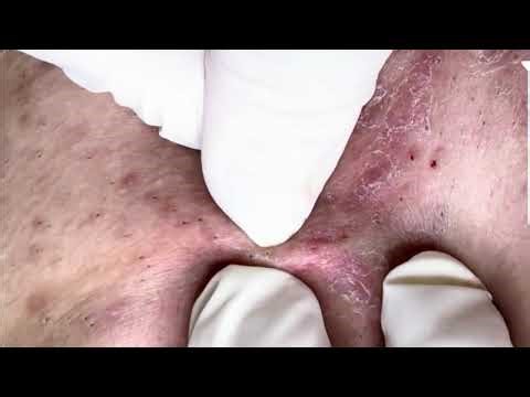 Extreme Acne & Scab Removal | Deep Pimple Popping for Severe Skin Recovery