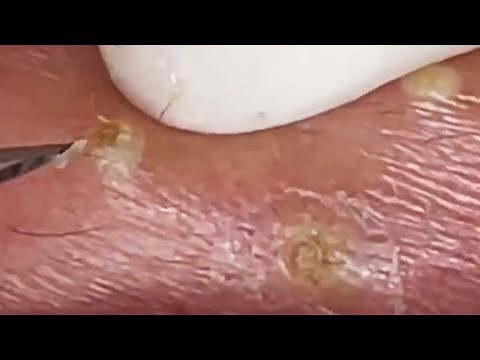Deep blackhead extraction Cystic acne & pimple popping #114