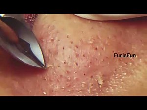 Removing Acne, blackheads tweezers