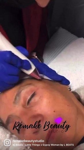 2.9K views | Plasma fibroblast works to decrease fine lines, wrinkles, & sagging skin discharging energy producing more collagen to repair the skin (956)378-7087 #remakeyourself #livetheexperience #skintight #plasma fibroblast #fibroblast #wrinklefree #nonsurgical #remakebeauty | ReMake Beauty Studio | Facebook