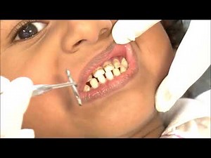 කිරි දත්