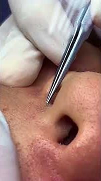 Pick sebaceous filaments