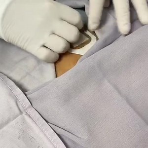 CT guided intratumoral immunotherapy into bone metastasis from prostate cancer. #immunotherapy #immunotherapyforcancer #thecureiswithinyou #williamscancerinstitute | Williams Cancer Institute