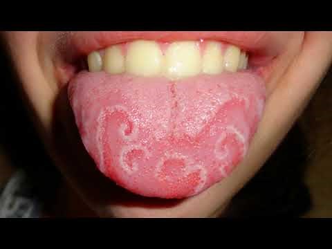 Difference Between Thrush, Herpes and Yeast Infection