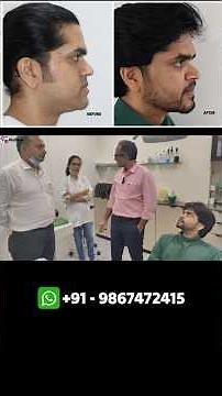 1 Month After Bi-Jaw + Genioplasty Surgery | Underbite Correction Recovery | Dr Parit Ladani