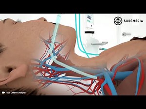 Mechanical Ventilation vs. ECMO (Extracorporeal Membrane Oxygenation): What is the Difference?