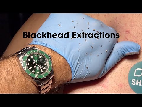FULL VIDEO Ultimate Blackhead Banishment: Professional Back Extractions Revealed (Blackhead Revenge)