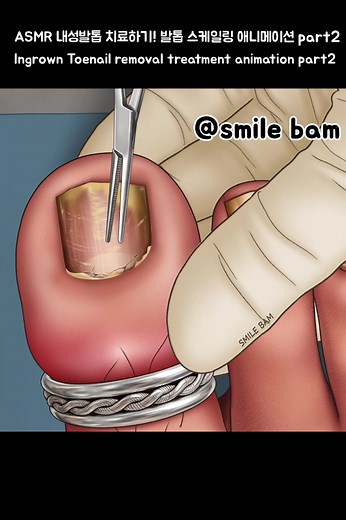 ASMR Ingrown Toenail Removal Animation