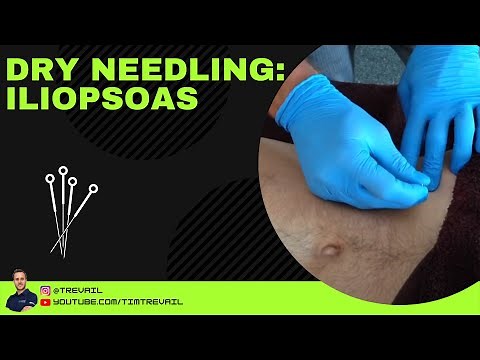 Dry Needling: Iliopsoas