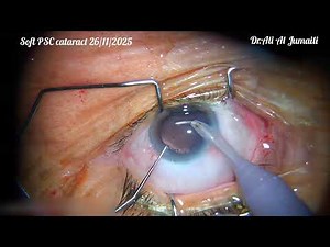 Phaco for Soft PSC cataract,retrieval extended CCC 26/11/2025