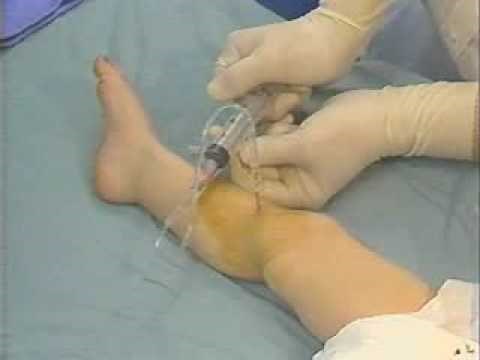 Cook IO needle insertion