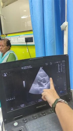 Dextrocardia on 2D echo