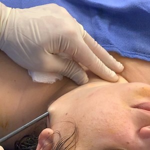 Loose skin and submental fat can be addressed with a minimally...