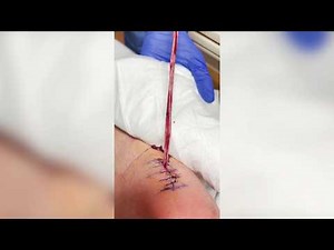 Satisfying Pimple Popping & Cyst Extractions - 170