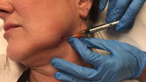 Kybella for jawline contouring