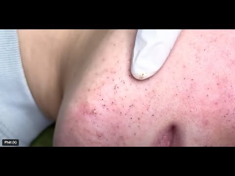 Extreme Acne & Scab Removal | Deep Pimple Popping for Severe Skin Recovery
