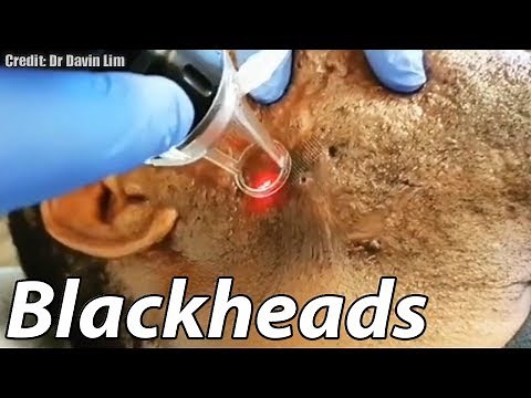 Worst Cystic Acne, Biggest Blackheads and GIANT Cyst Removal