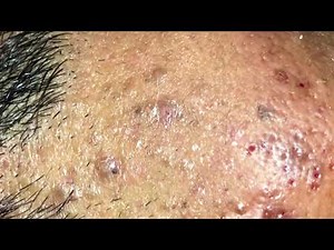 DEEP BLACKHEADS PART-2 by Dr.Lalit Kasana