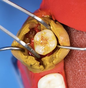 1.1M views · 1.2K reactions | What really happens during dental surgery | Green Bean | Facebook