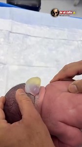 67 reactions · 31 comments | ENCEPHALOCELE. Encephalocele is a neural tube defect characterized by sac-like protrusions of the brain and the membranes that cover it through openings in the skull. These defects are caused by failure of the neural tube to close completely during fetal development. know your health and stay safe #healthiswealth 喙 | Osiemo Daktari | Facebook