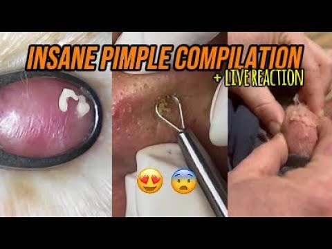 Ultimate Pimple Popping Compilation 😨 | 8 Minutes of Pure Satisfaction