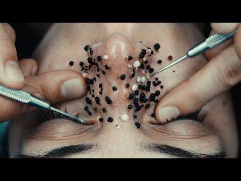 Extreme Blackhead Removal 😱 | Satisfying Deep Extraction ASMR