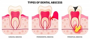 What Is a Tooth Abscess? Symptoms, Causes, and Treatment