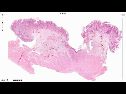 Peptic Ulcer - Histopathology