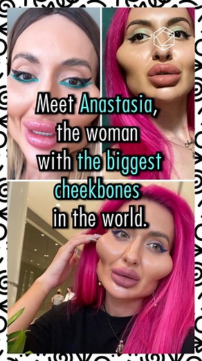 Meet Anastasia, the woman with the biggest cheekbones in the world #socialmedia #cheekbones #surgery #plasticsurgery #botox #veneers #liposuction #modification #weird #strange #mentalhealth #psychology #face #injections #model #ukranian | Cultura Colectiva