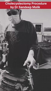 8.8K views · 27 reactions | Cholecystectomy Procedure by Dr Sandeep Malik #cholecystectomy #gallbladdersurgery #gallbladderremoval #gallbladder #surgery #surgeon #medical #OperationTheatreTechnician | Medication Knowledge | Facebook