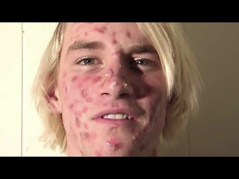 ZIT FACE GUY - PIMPLE ACNE EXPLOSION!!!!!