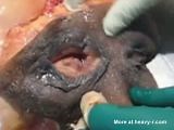 Removal Of Vagina