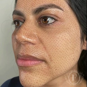 Full Plasma Facelift✨ This full coverage treatment takes 8-10 weeks...