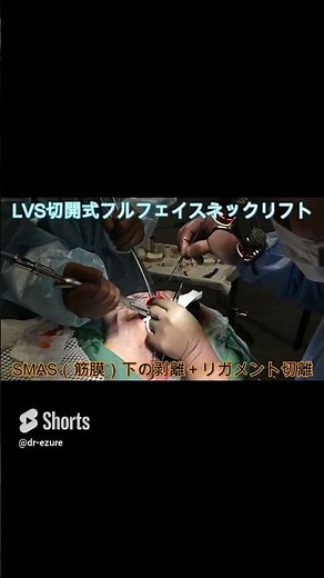【閲覧注意・手術動画】切開式フェイスリフトのSMAS（筋膜）下剥離・50代女性の顔のたるみ取り・整形で若返りたいミドルシニア層の女性